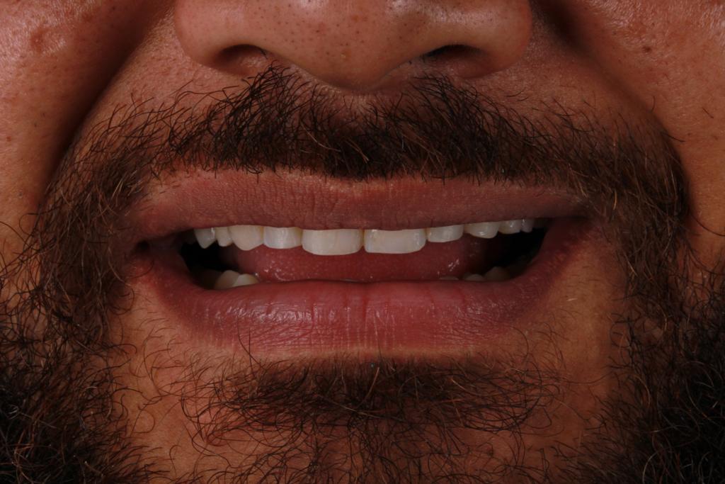 Antes diseño dental